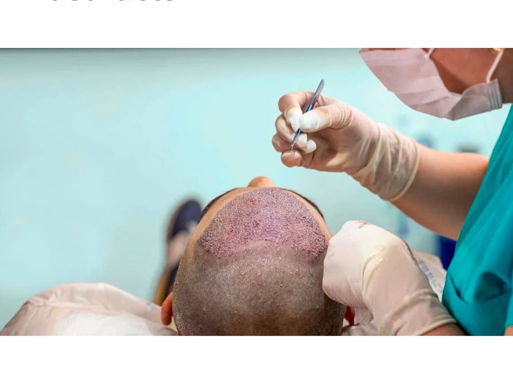 Transplant Hair In Pakistan